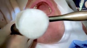 IDR - Immediate Dentoalveolar Restoration FULL Case - Brazil Oct-2020