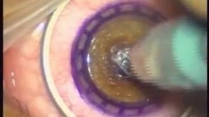 Mushroom Keratoplasty