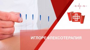 Иглорефлексотерапия