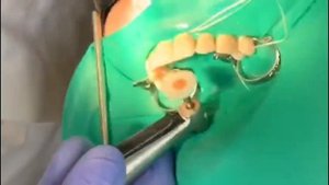 Лечение Кариеса