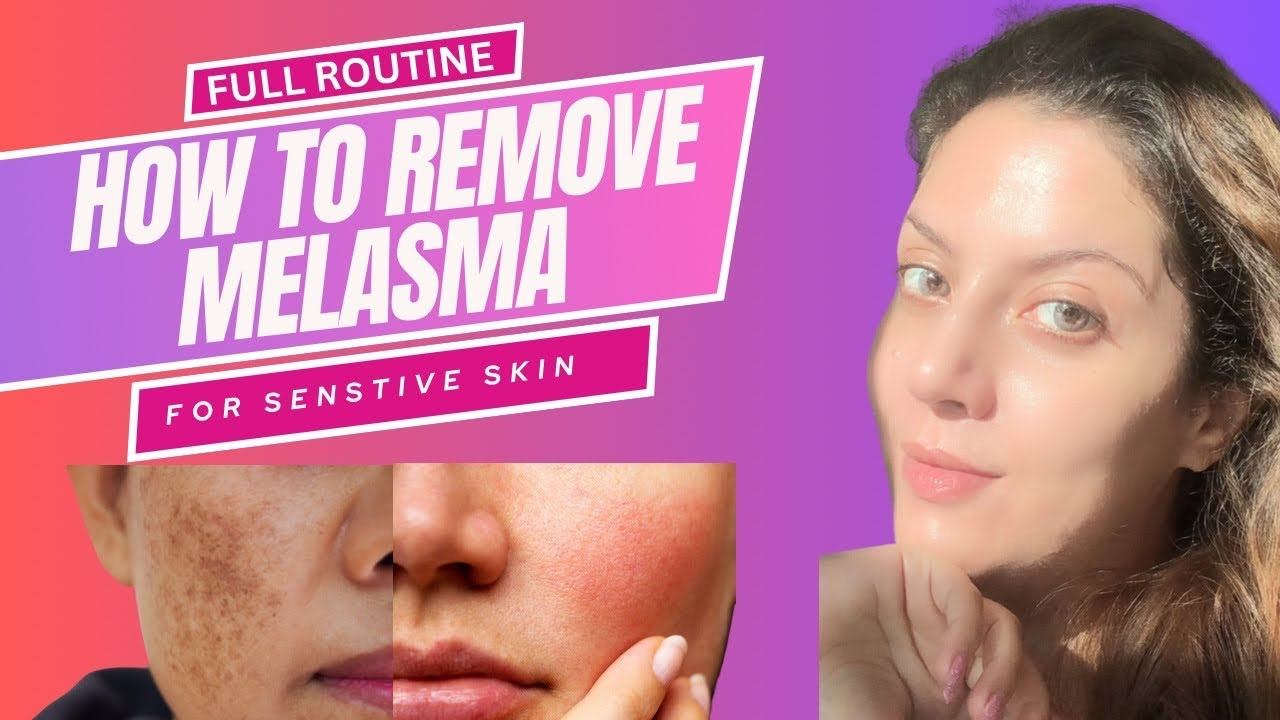How to Remove Melasma at Home I Sensitive Skin Care I  Sensitive Skin Care Products in Hindi