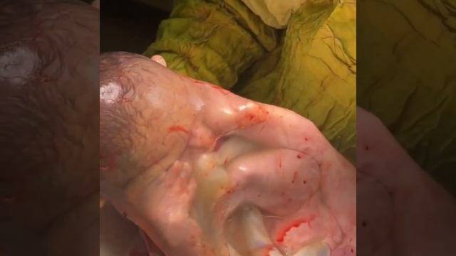 एमनियोटिक सैक में पैदा हुए बच्चे का ये वीडियो आप भी देखें ? #Birth #childbirth #baby