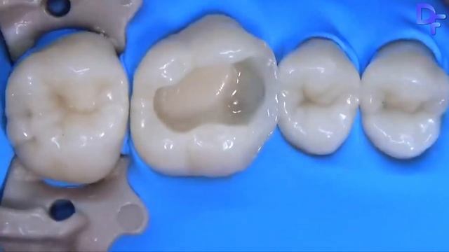 Estelite Posterior – ваш идеал в пломбировании объемных полостей жевательных зубов смотреть онлайн