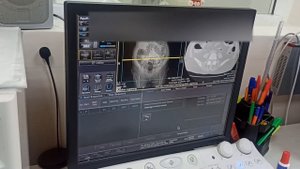 Виртуальная колоноскопия