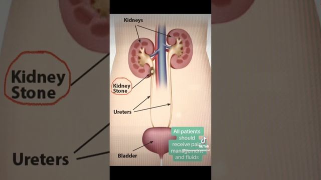 Kidney Stones #medicine #educational #medical #nephrology #fypシ #foryou #fyp #kidneystone #kidney