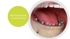 Протезирование на имплантатах при полной потери зубов