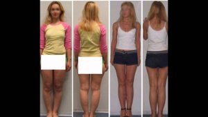 как хирурги ломают кривые ноги