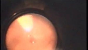 Лазеркоагуляция. Ретинопатия недоношенных.