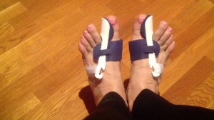 Как избавиться от косточки на ногах. Здоровые ножки.3