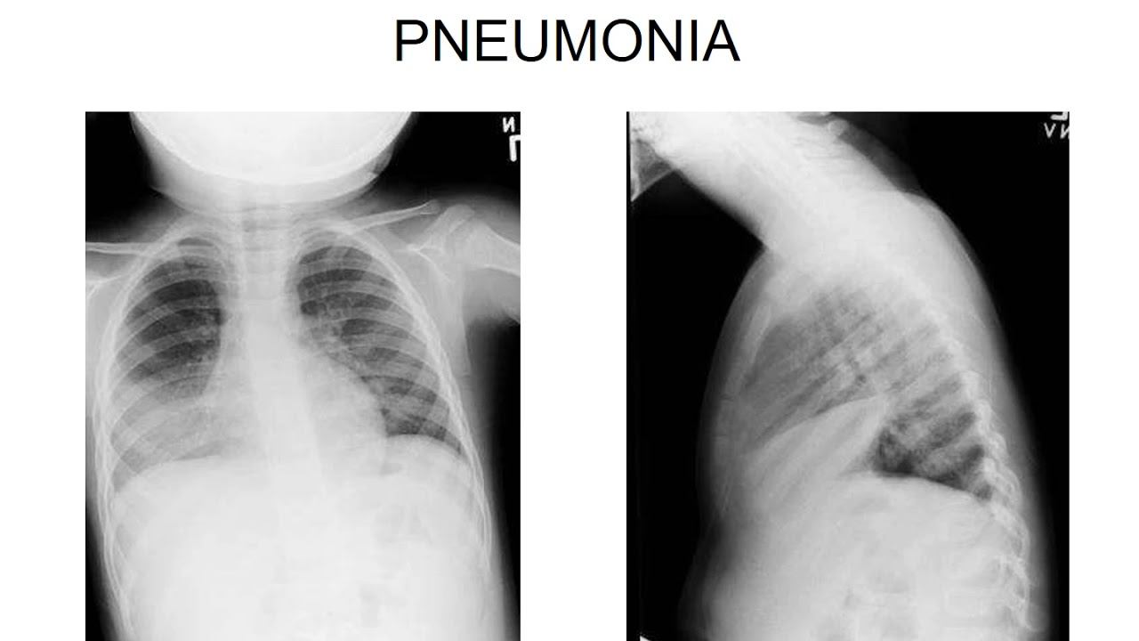 Pediatric Pneumonia by Dr Anup Kumar