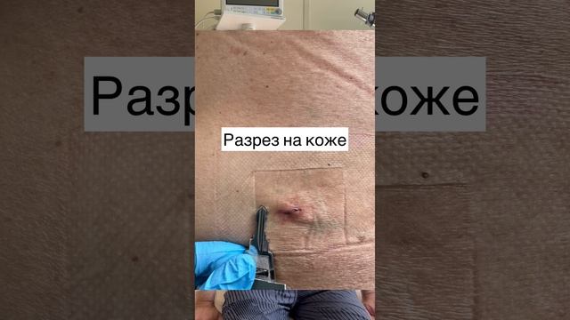 Секвестрированная грыжа | Отзыв пациента после операции