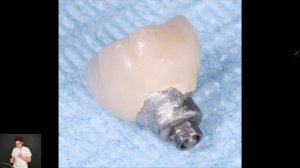 Мягкотканная пластика. Протокол увеличения объема мягких тканей вокруг имплантата.