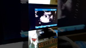 Узи  14 недель