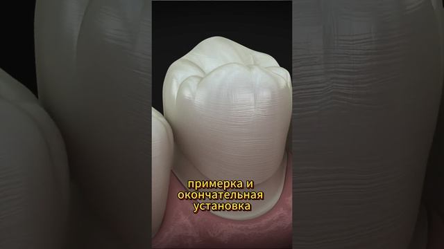 Коронки для Зубов