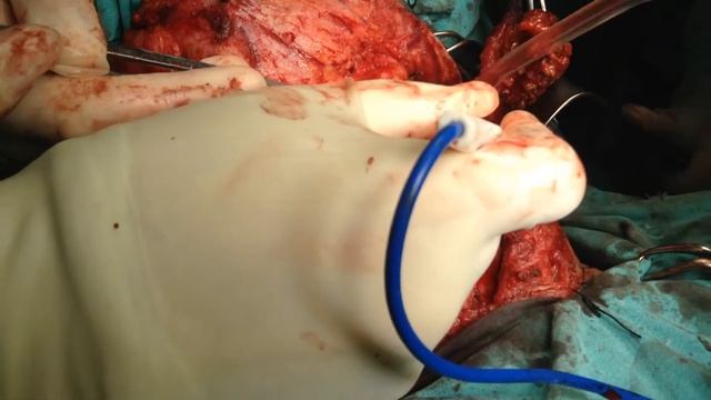 Prof. Aziz Aliyev. Thyroid Surgery With Lymph Node Dissection смотреть онлайн