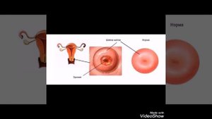 Эрозияни уй шароитида даволаш энг осон усули