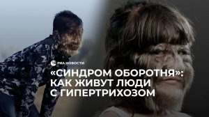 "Сидром оборотня": как живут люди с гипертрихозом