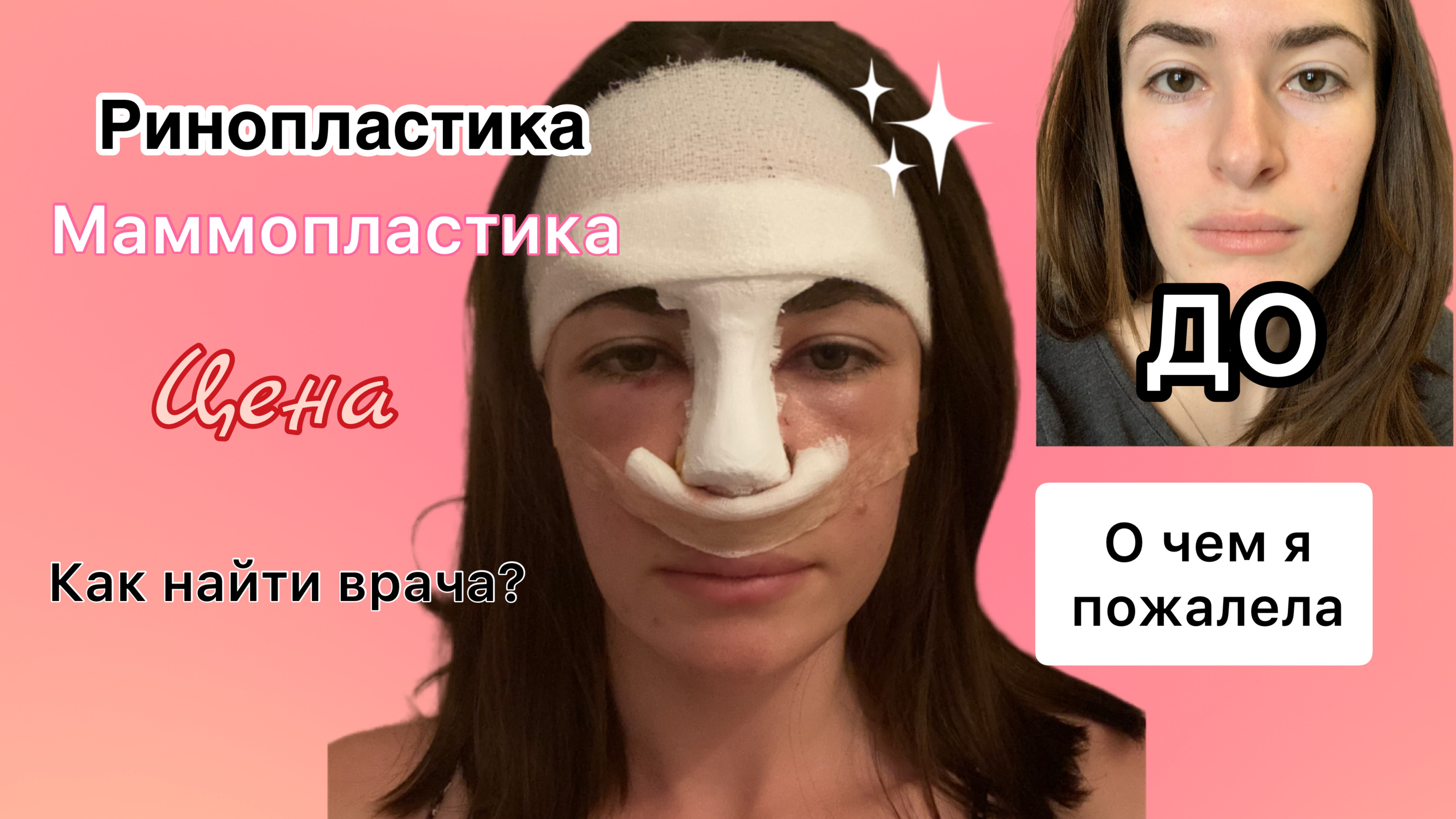 Дневник пластики #1  Мои операции: Ринопластика спустя 4 года, минусы, цены.
 Маммопластика