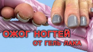 Испортили ногти - ожог. Мастер привела своего клиента.