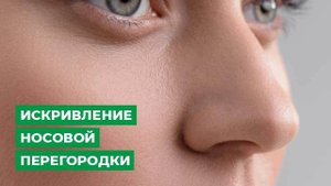 Искривление носовой перегородки