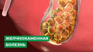 Желчнокаменная болезнь
