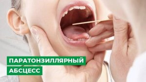 Паратонзиллярный абсцесс
