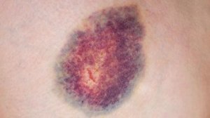 Как рассосать уплотнение при лактостазе?