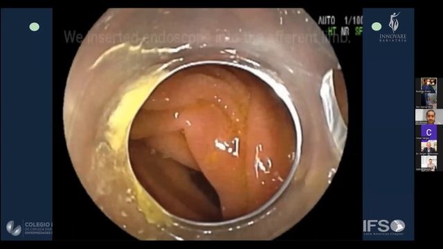 Sesión Académica de Alta Especialidad: "Tratamiento de la coledocolitiasis post bypass" смотреть онлайн