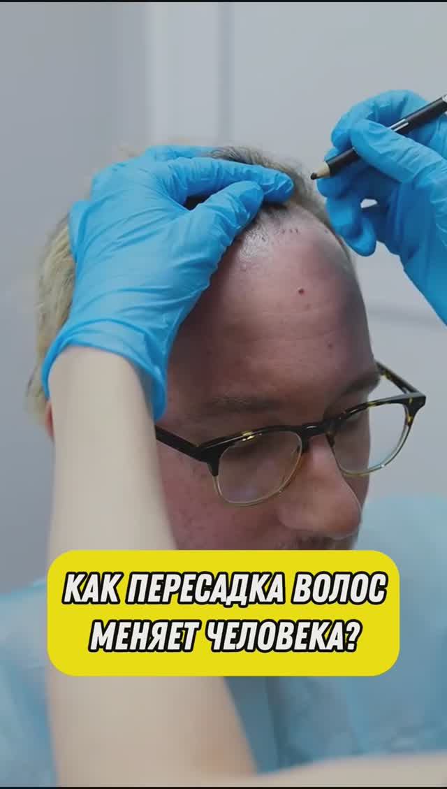 Как пересадка волос меняет человека #ПересадкаВолосВСтамбуле #ПересадкаВолосМосква #ПересадкаВолос