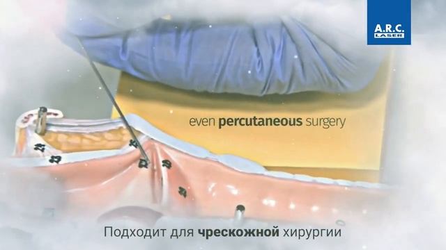 Синий лазер TruBlue 445 нм для минимально инвазивной хирургии смотреть онлайн