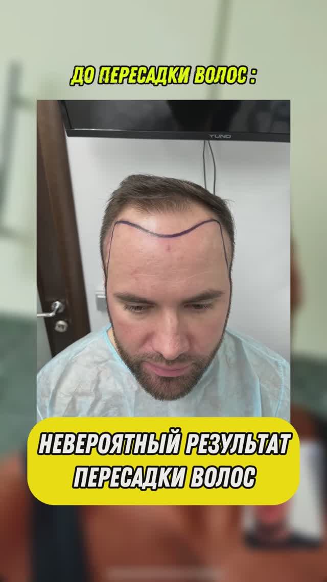 Результаты #ПересадкаВолосМосква #ПересадкаВолосРезультаты
