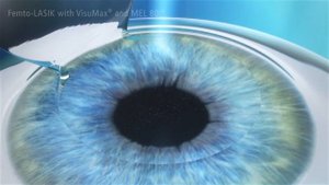 Femto Lasik - Zeiss
