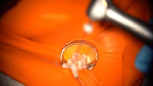 Эндодонтическое лечение премоляра с объяснением