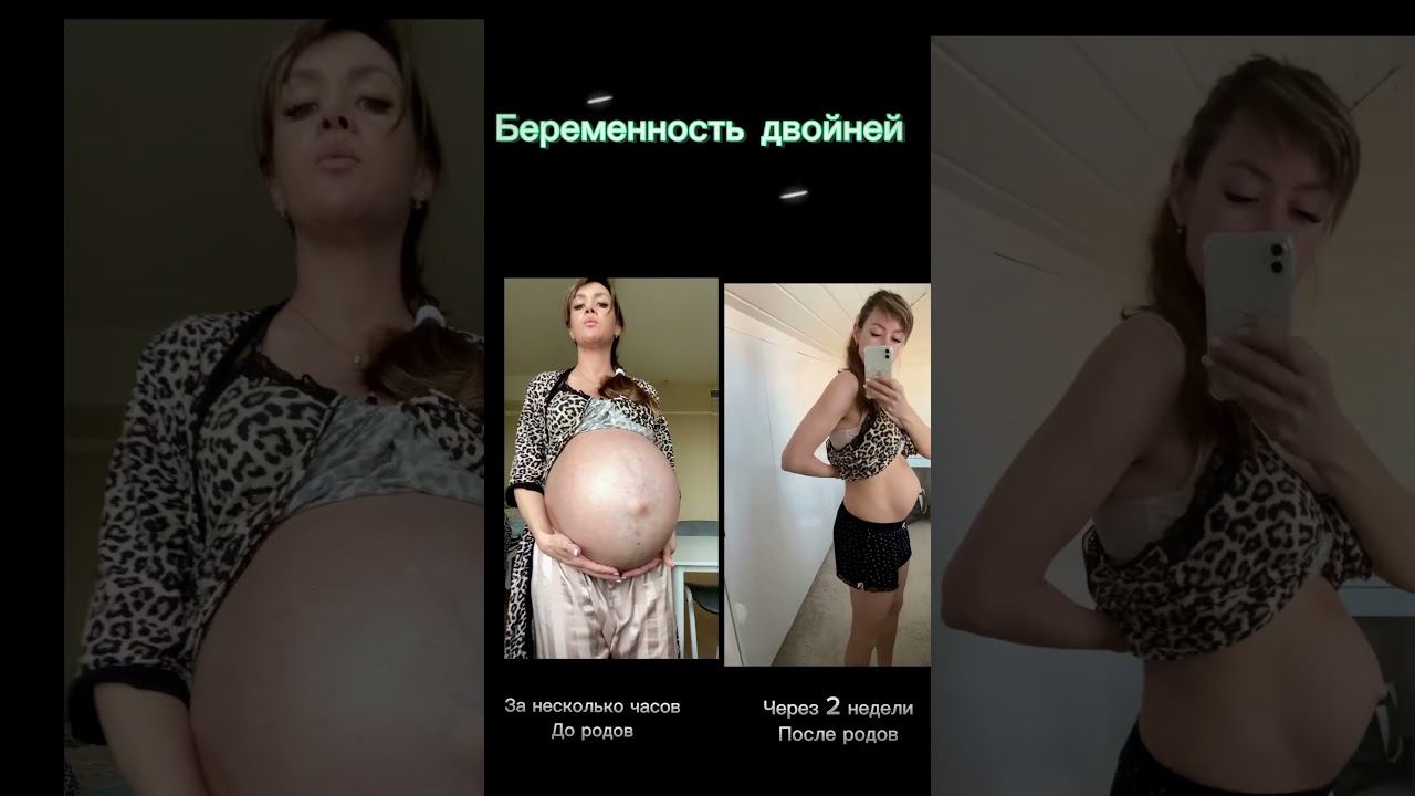 #беременность#двойня#близнецы#роды#роддом#животпослеродов#животсдвойней#похудетьбыстро