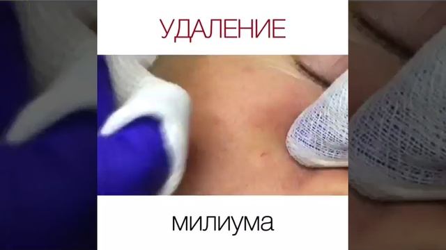 Удаление милиума смотреть онлайн