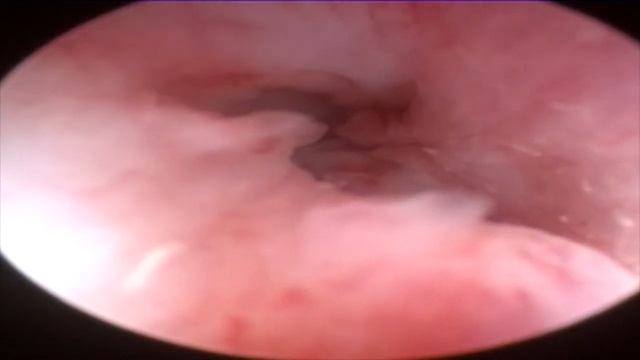 Стеноз/стриктура уретры смотреть онлайн