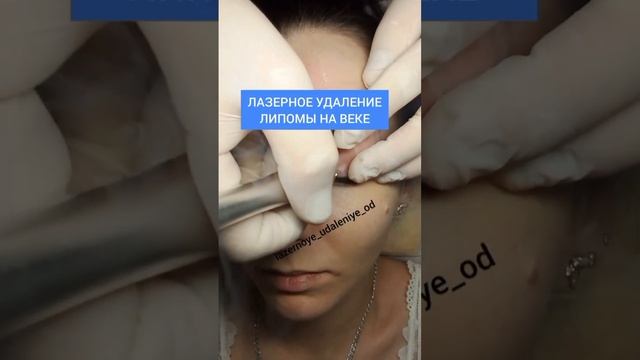 Лазерное удаление липомы на веке