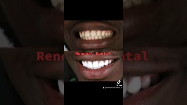 Renewal #dental #hollywood #smile смотреть онлайн