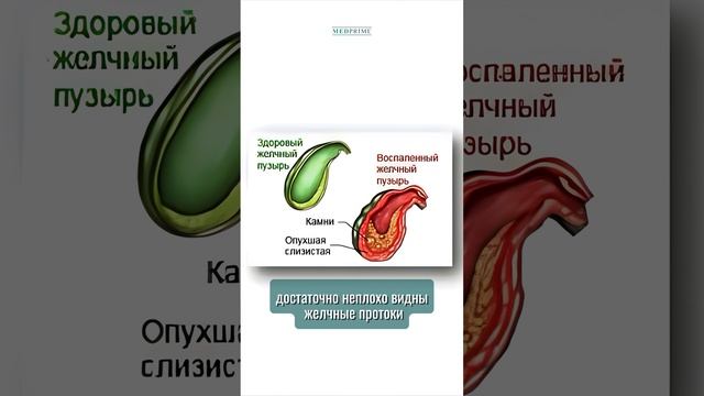 УЗИ-диагностика заболеваний желчного пузыря, печени и других органов брюшной полости
