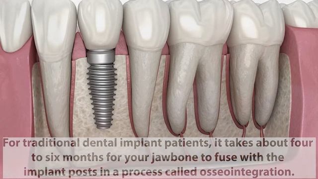 Dental Implant Timeline