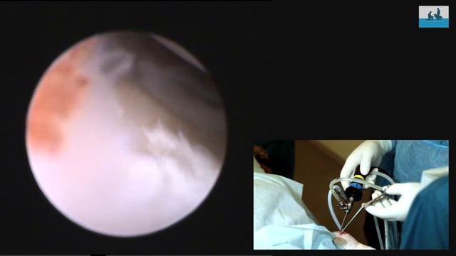 Артроскопия. Arthroscopy