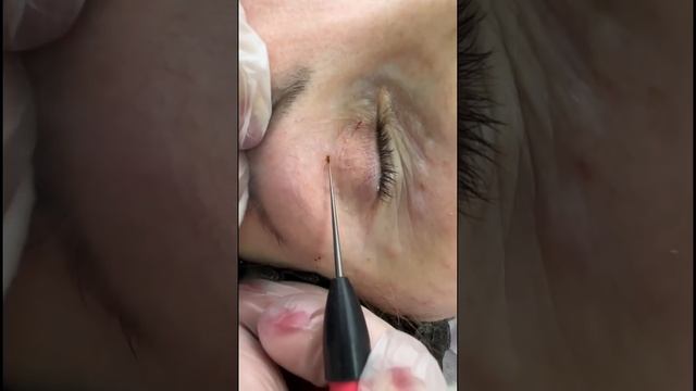 Удаление папиллом с глаз смотреть онлайн