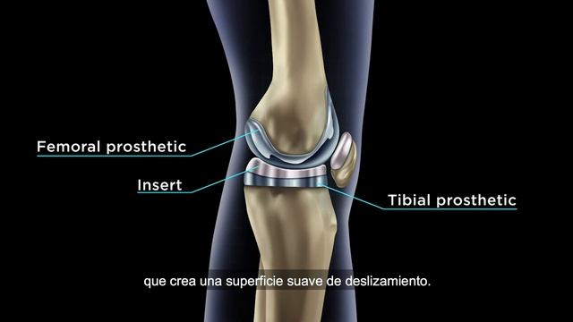 Reemplazo de su rodilla (Your Knee Replacement) смотреть онлайн
