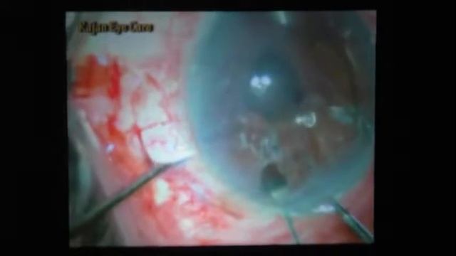 Sujatha Mohan (India) Lamelllar keratoplasty смотреть онлайн