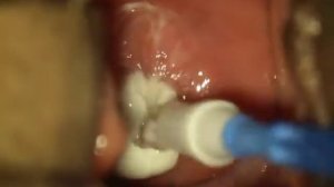 Imiquimod application in the cervix.