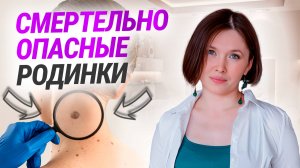 Проверь эти пять признаков ОПАСНЫХ родинок! Эффективное удаление родинок