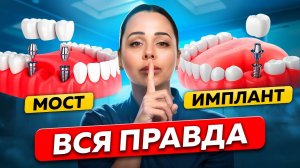 Ошибки, которых можно избежать! Имплант или Мостовой Протез: вся правда от стоматолога