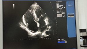 Спустя 5 дней после тромболизиса по поводу тяжелой ТЭЛА