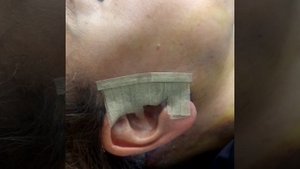 Перевязка  после круговой подтяжки лица.