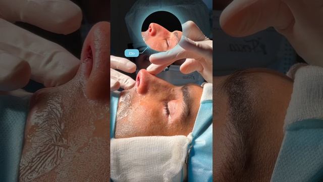 Результат мужской риносептопластики на операционном столе 🔥